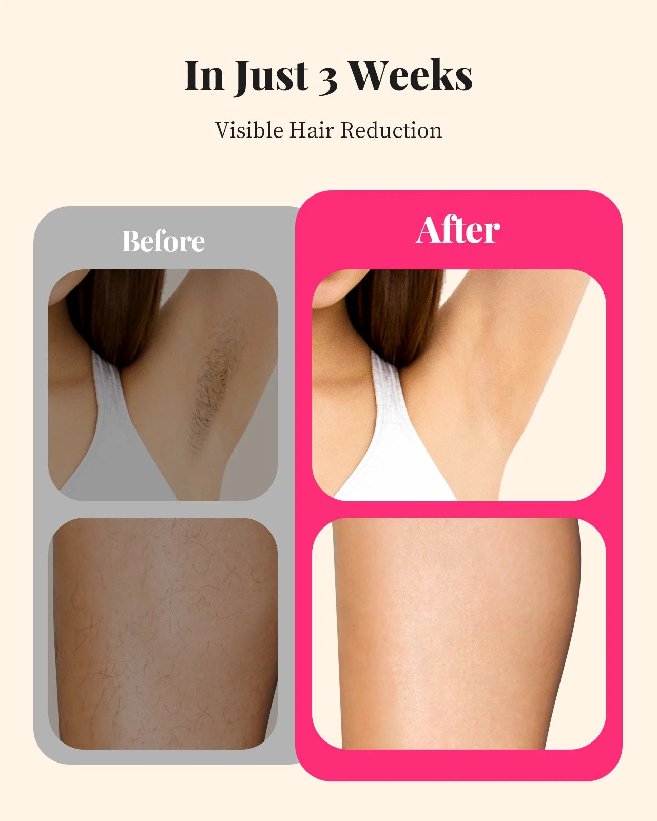 ✨💖 990000 Flashes IPL Laser Hair Removal Device – Painless Permanent Hair Remover for Women & Men